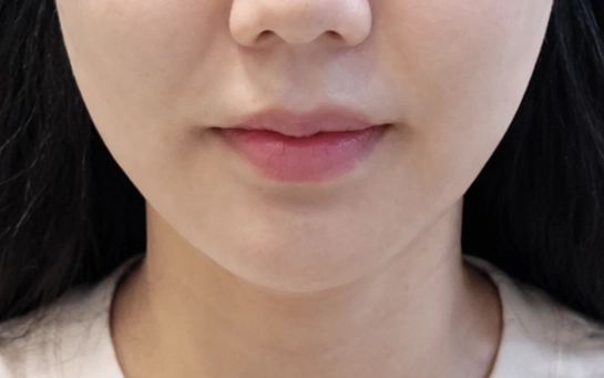 미니리프팅 전